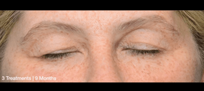 Denis Branson Eyes After
