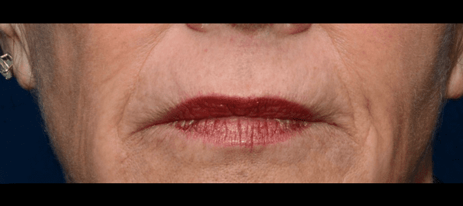 Denis Branson Mouth Before