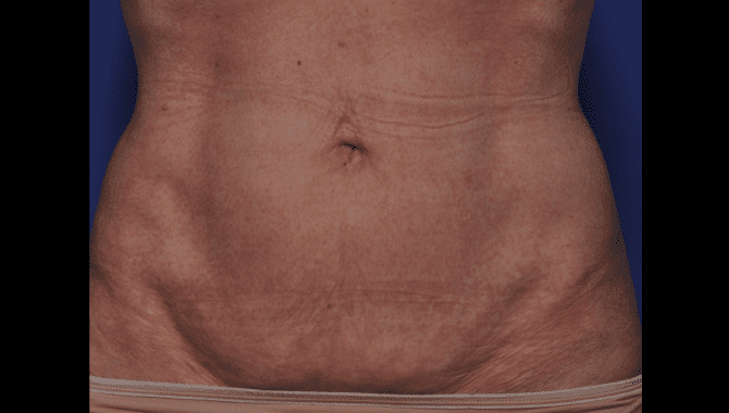 Dibernardo-Abdomen-After