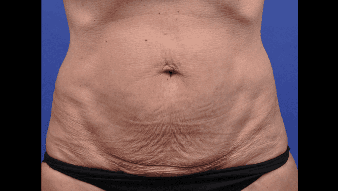 Dibernardo-Abdomen-Before