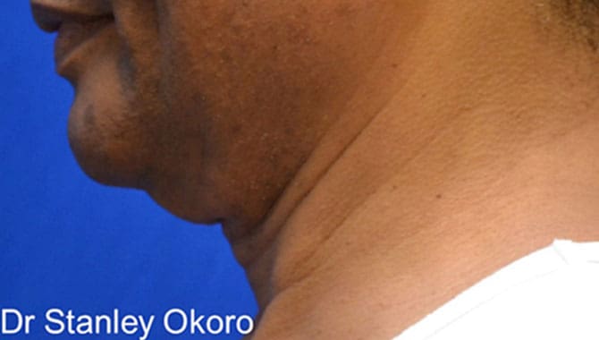 ThermiTight_Stanley_Okoro_Before