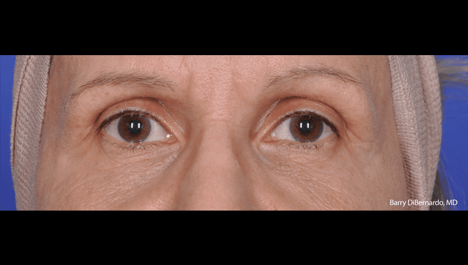 thermismoothface-barrydibernardoeyes-after