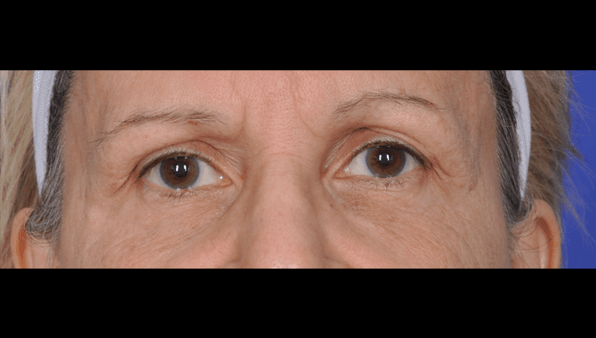 thermismoothface-barrydibernardoeyes-before