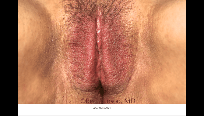 thermiva-patient1-after