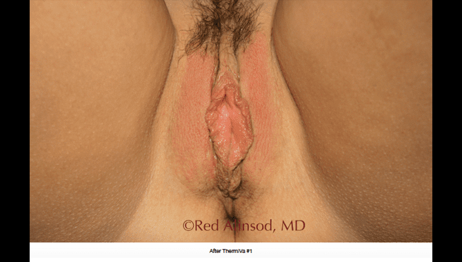 thermiva-patient2-after