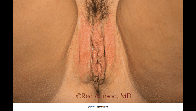 thermiva-patient2-before