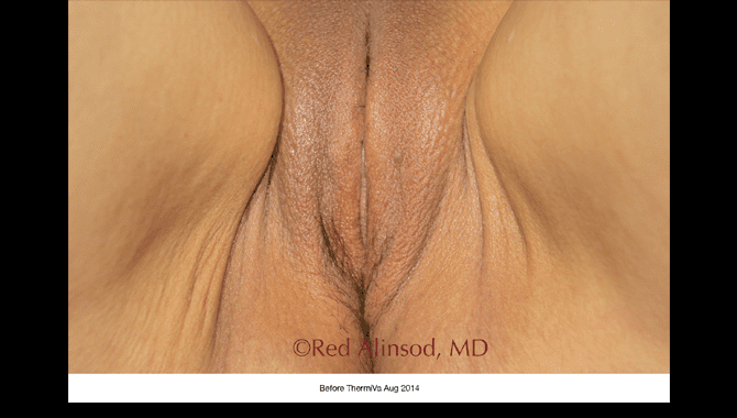 thermiva-patient3-before