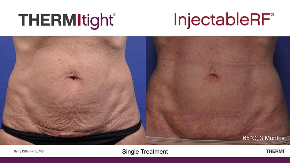 before and after mini tummy tuck recovery