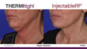 Thermi Facelift Jowls
