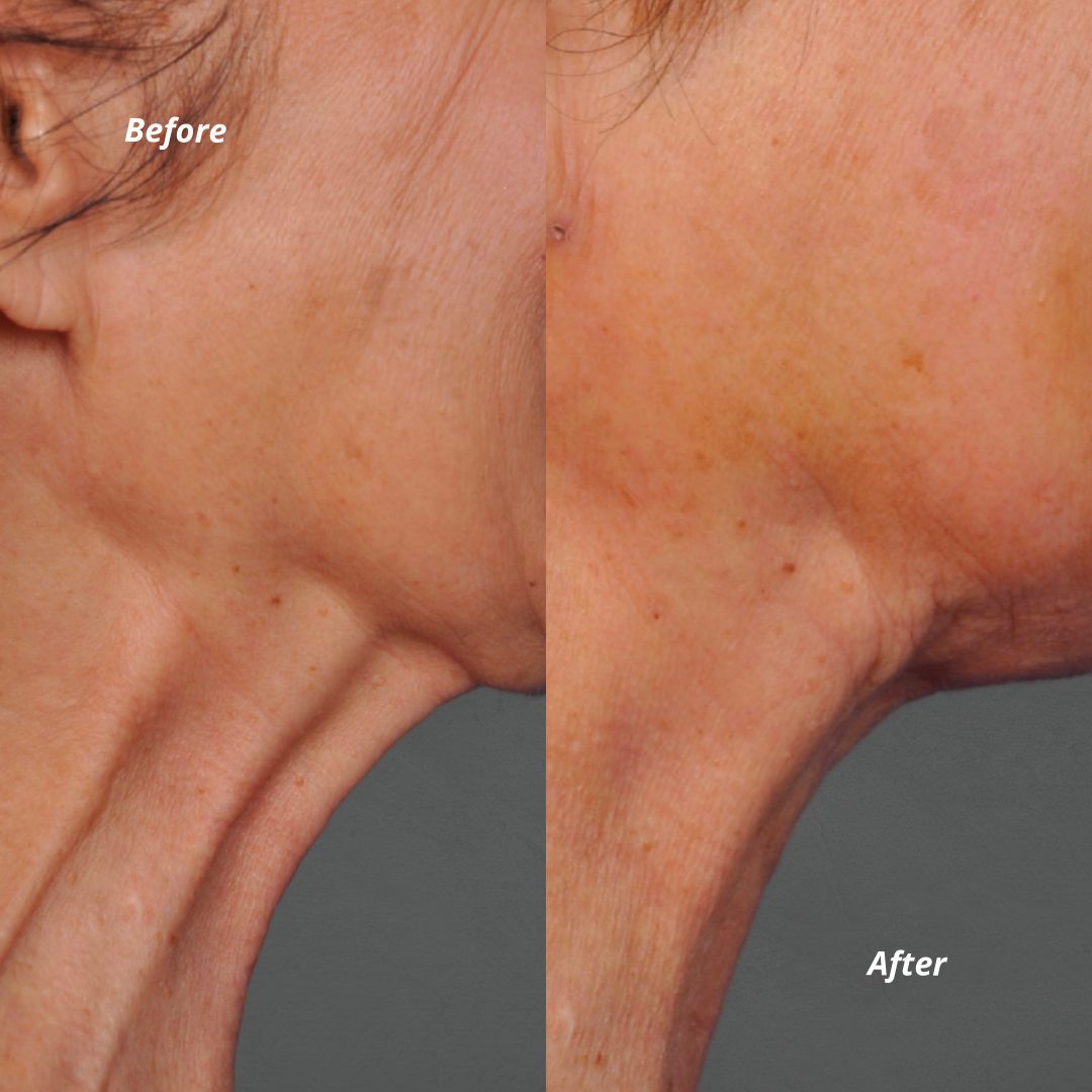 Before & After - Eyes