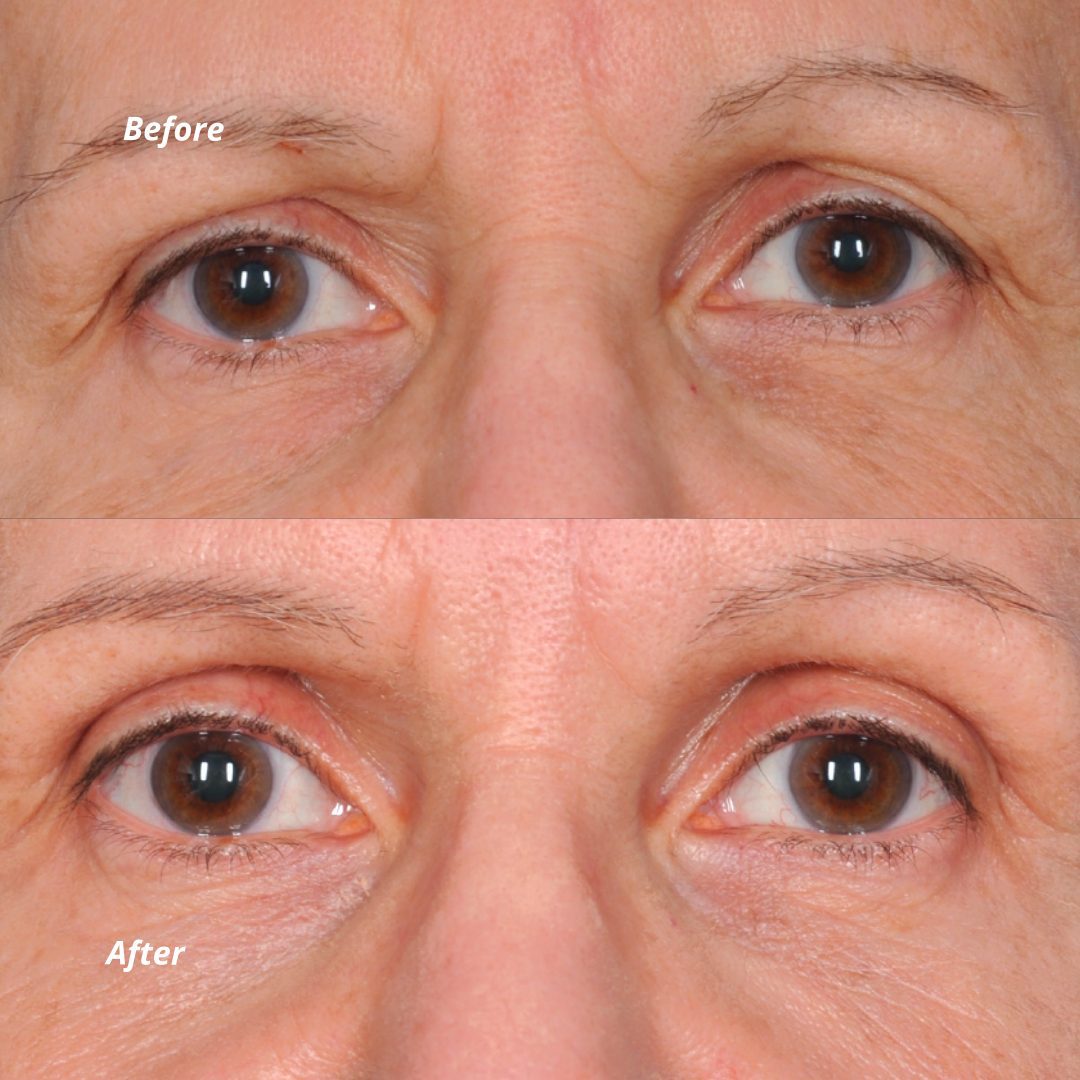 Before & After - Eyes Close-Up