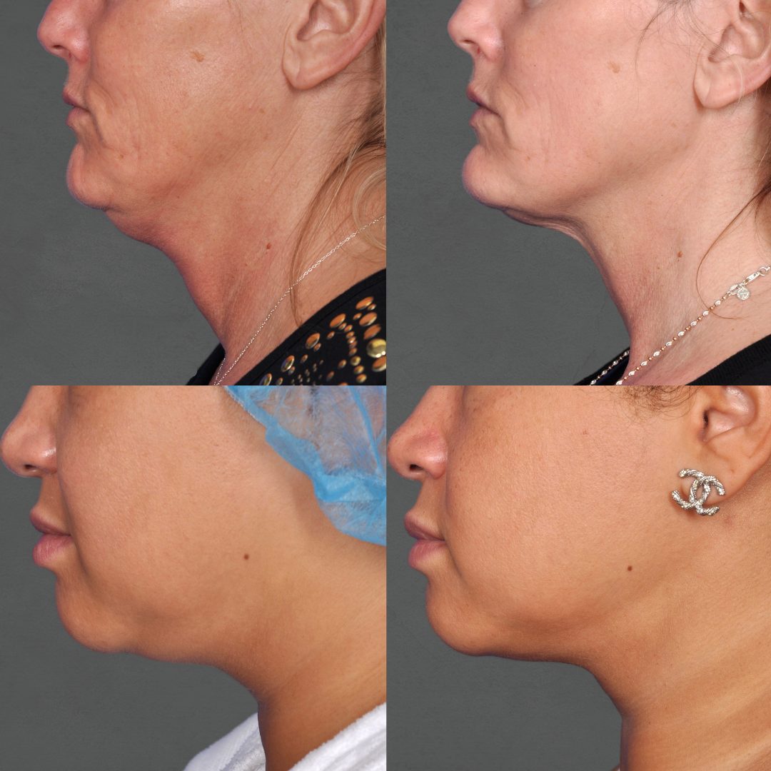 Before & After - Face Side View