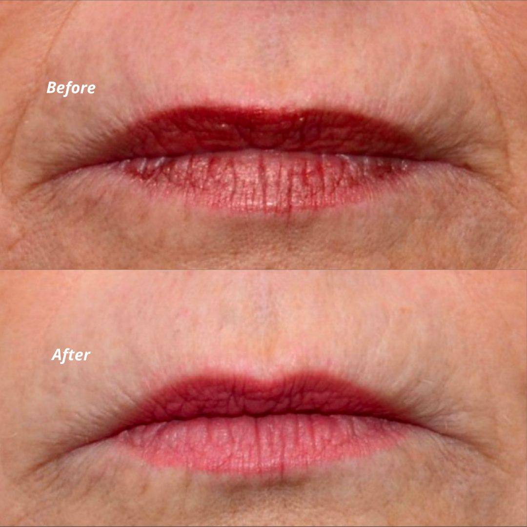 Before & After - Lips