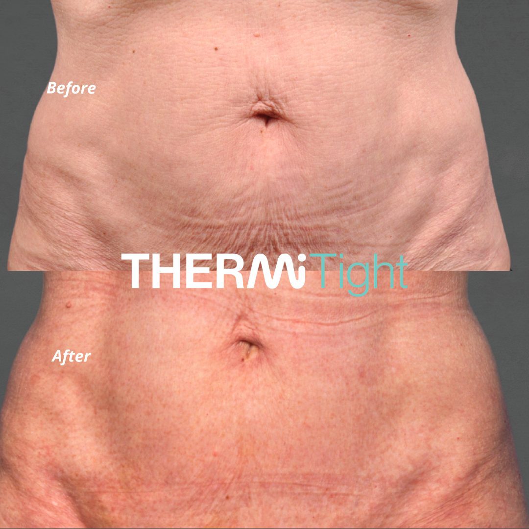 Before & After - ThermiTight Body